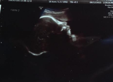 Baby B, 32 weeks (Baby A was camera shy)